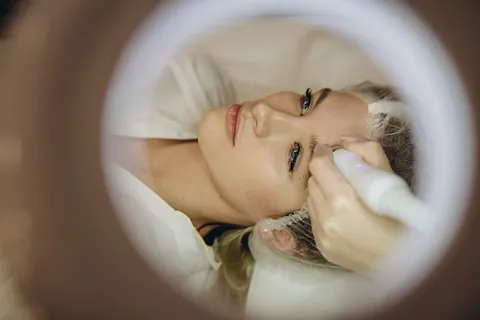 microdermabrasion